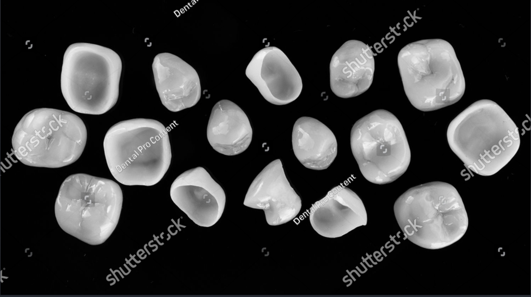 Close-up of a natural-looking dental crown