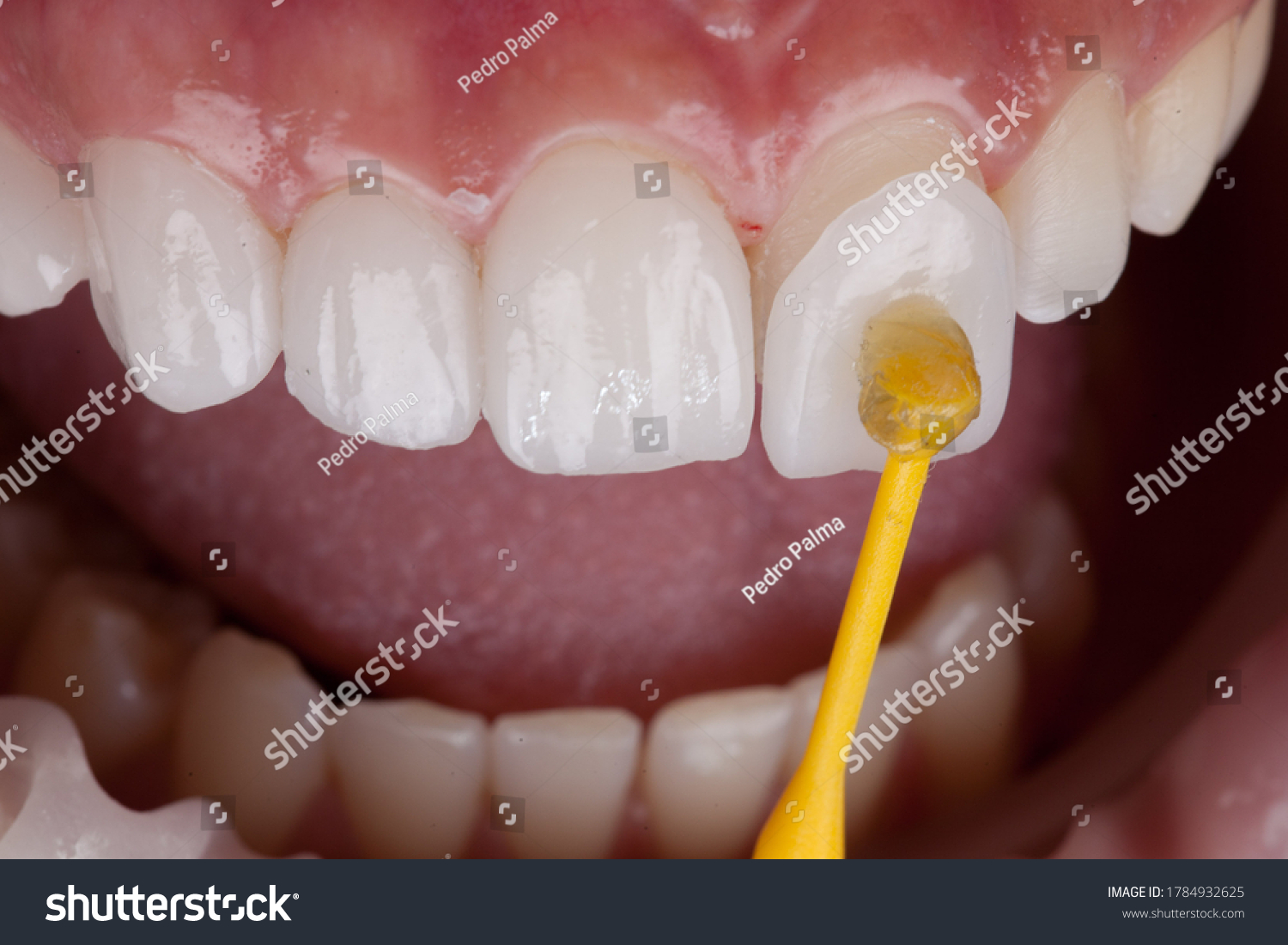 Porcelain veneers — natural, balanced smile