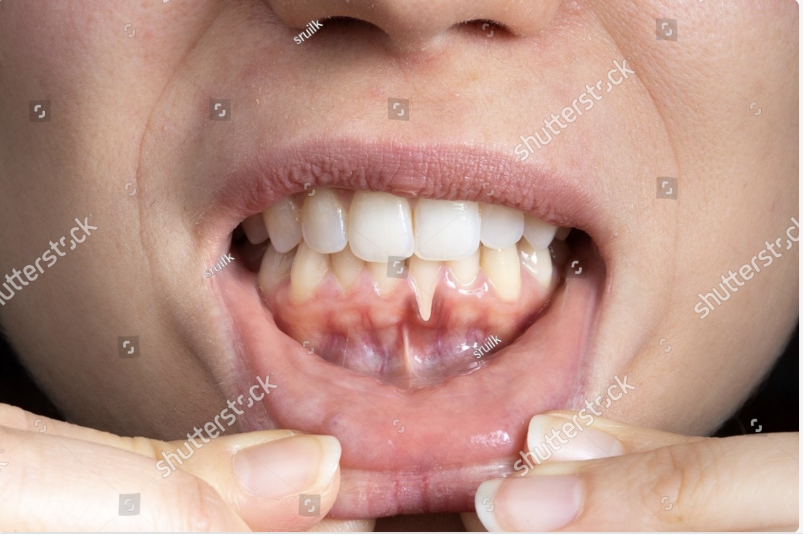 Healthy gums surrounding teeth after periodontal therapy