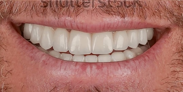 Before and after comparison