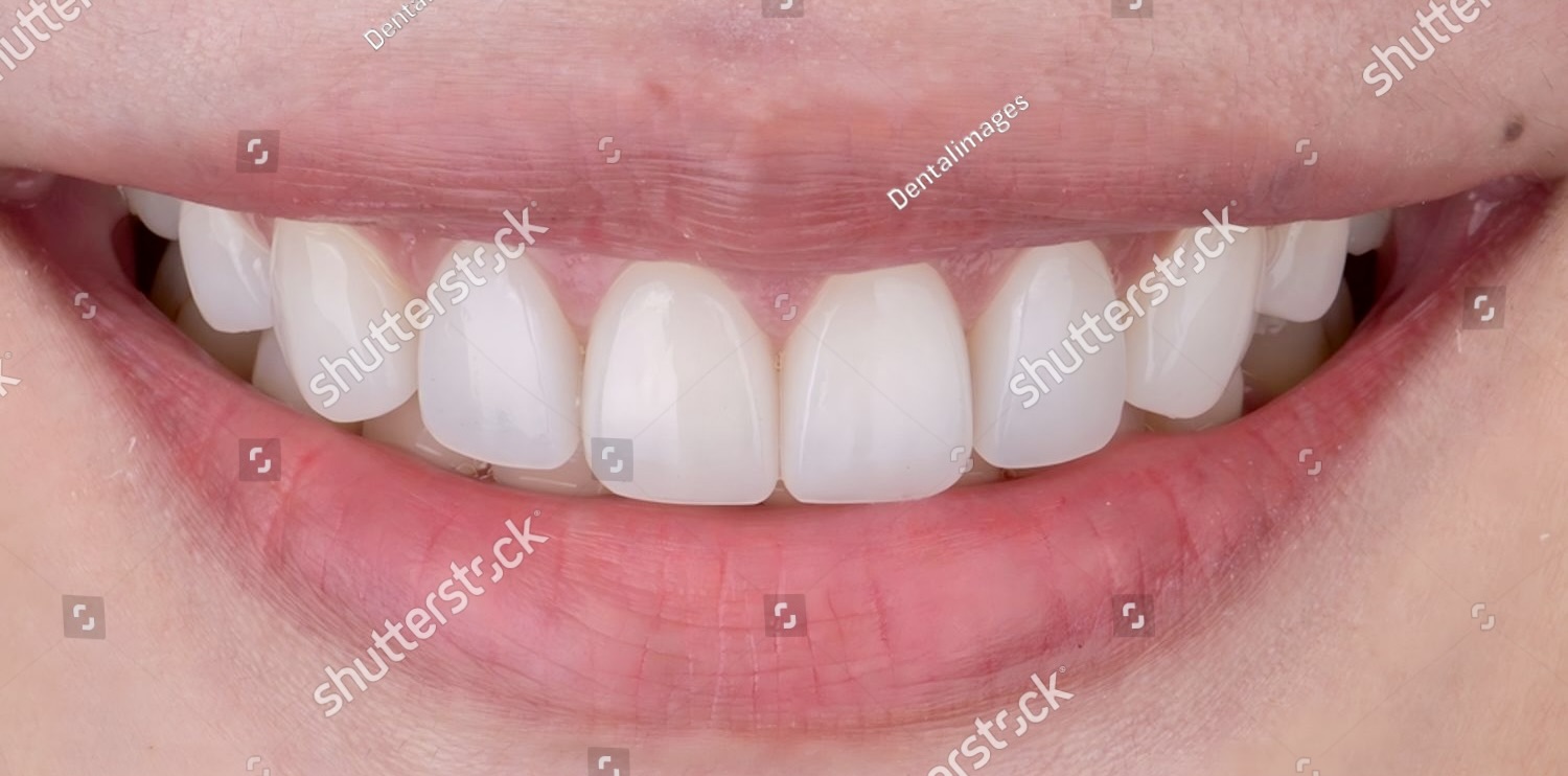 Before and after comparison