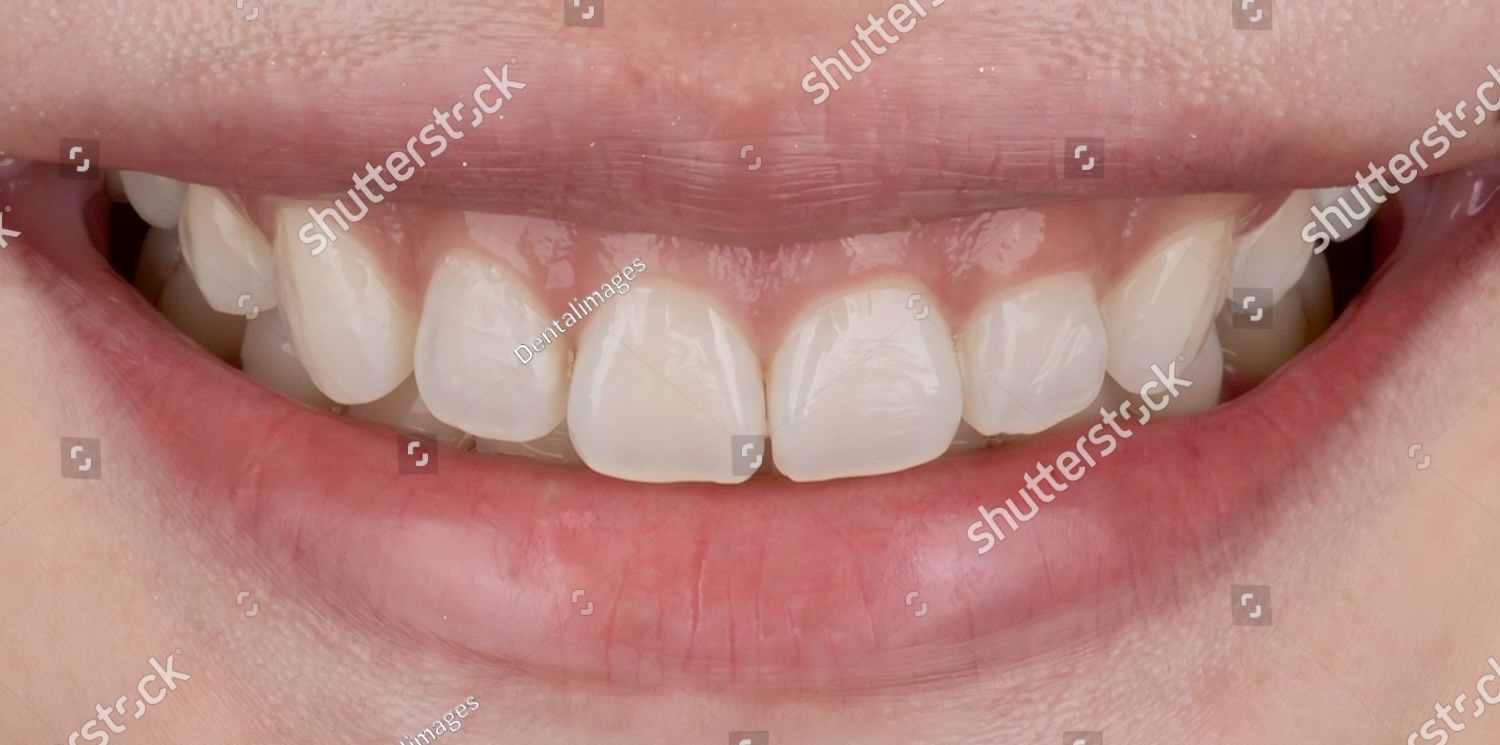 Before and after comparison